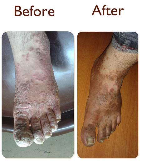 Case 2: Erythrodermic Psoriasis - 28 years